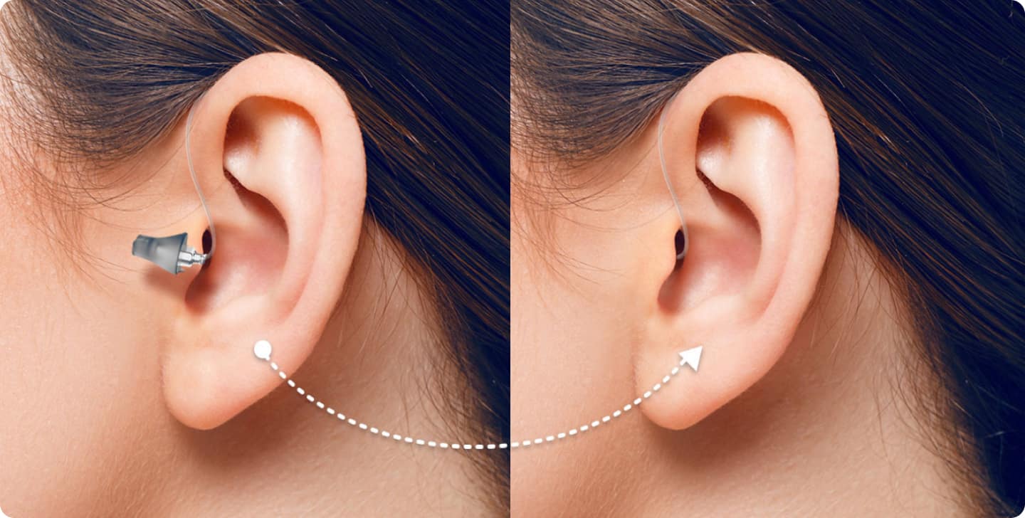 twee afbeeldingen zijn te zien van de het oor van een vrouw met bruin haar. In haar hoor is het achter-het-oor hoortoestell te zien.