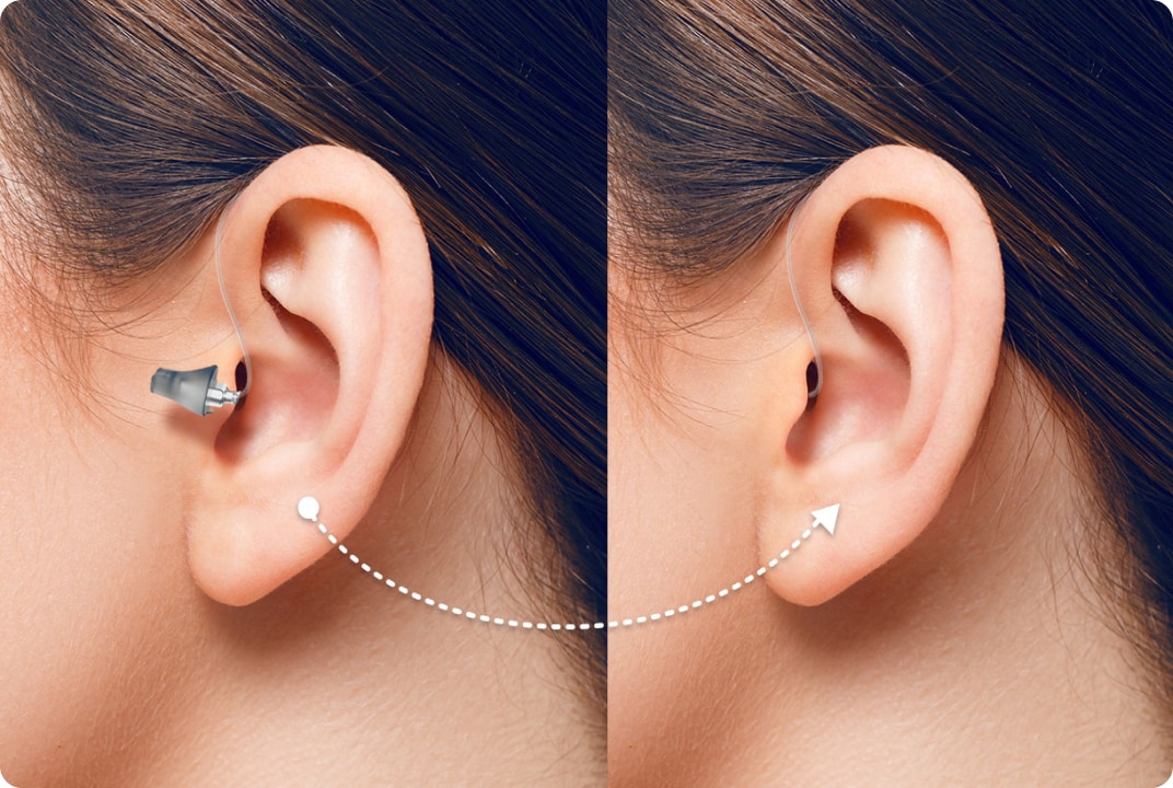 twee afbeeldingen zijn te zien van de het oor van een vrouw met bruin haar. In haar hoor is het achter-het-oor hoortoestell te zien.