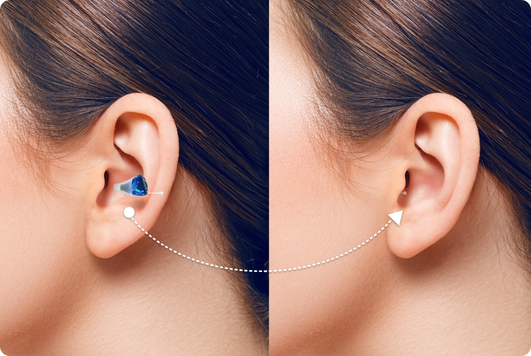 twee afbeeldingen zijn te zien van de het oor van een vrouw met bruin haar. In haar hoor is het in-het-oor hoortoestell te zien.